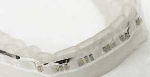 Dental-brace-pics_Page_5-296x152